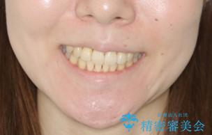 本来は外科ケース:インビザラインで前歯の重度がたつきとオープンバイトの改善の治療後(顔貌)