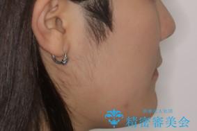 出っ歯と深い噛み合わせ:抜歯矯正で口元スッキリ!の治療後(顔貌)