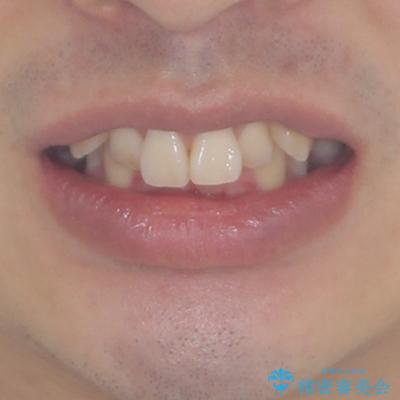 八重歯の抜歯矯正 インビザラインを用いて気になる歯並びを改善の治療前(顔貌)