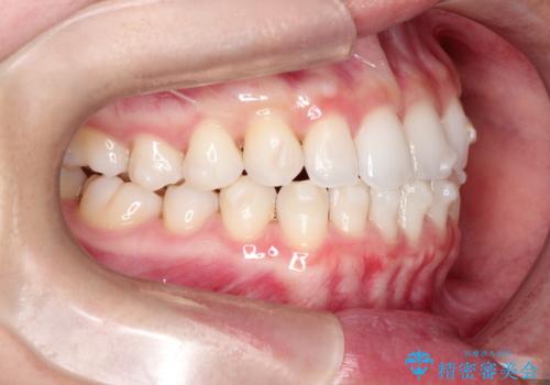 【インビザライン】前歯の凸凹をマウスピース矯正でなおしたいの治療中