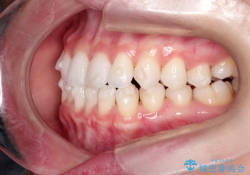 【インビザライン】前歯の凸凹をマウスピース矯正でなおしたいの治療中