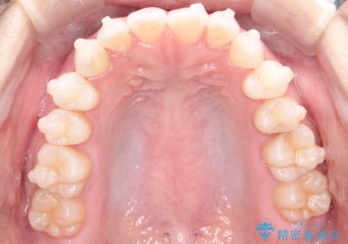 【インビザライン】前歯の凸凹をマウスピース矯正でなおしたいの治療中