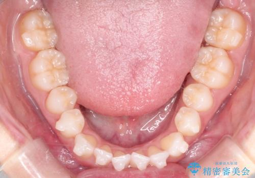 【インビザライン】前歯の凸凹をマウスピース矯正でなおしたいの治療中