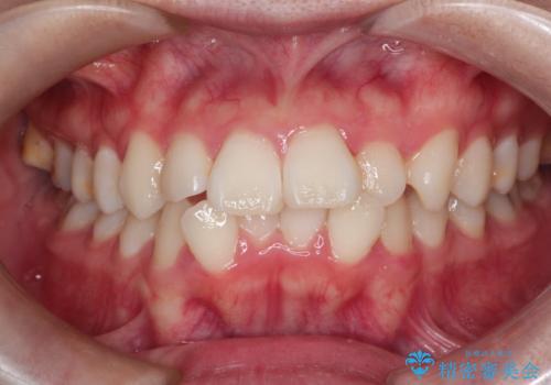 【抜歯ワイヤー矯正】前歯を引っ込めたいの治療前