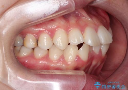 【抜歯ワイヤー矯正】前歯を引っ込めたいの治療前