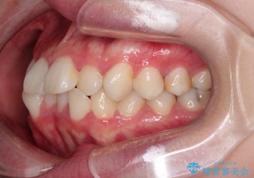 【抜歯ワイヤー矯正】前歯を引っ込めたいの治療前