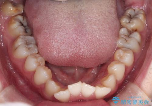 【抜歯ワイヤー矯正】前歯を引っ込めたいの治療前