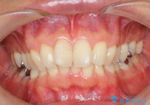 【遠心移動ワイヤー矯正】翼状捻転を治したいの症例 治療前