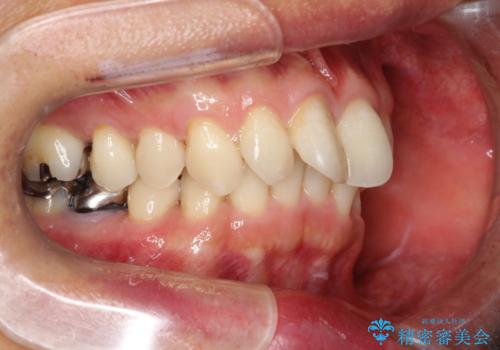 【遠心移動ワイヤー矯正】翼状捻転を治したいの治療前