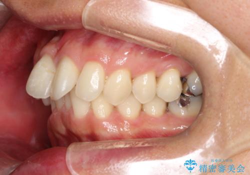 【遠心移動ワイヤー矯正】翼状捻転を治したいの治療前