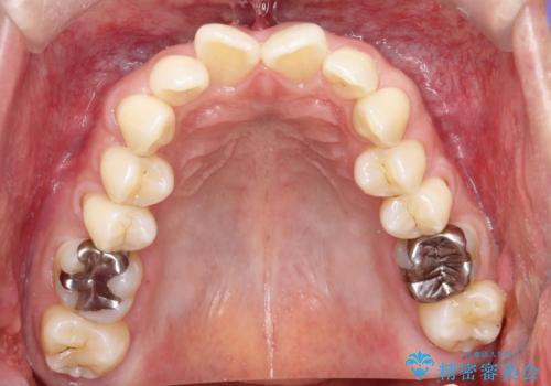 【遠心移動ワイヤー矯正】翼状捻転を治したいの治療前