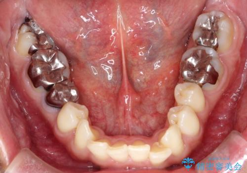 【遠心移動ワイヤー矯正】翼状捻転を治したいの治療前