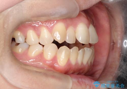 【インビザライン】オープンバイトを治したいの治療前