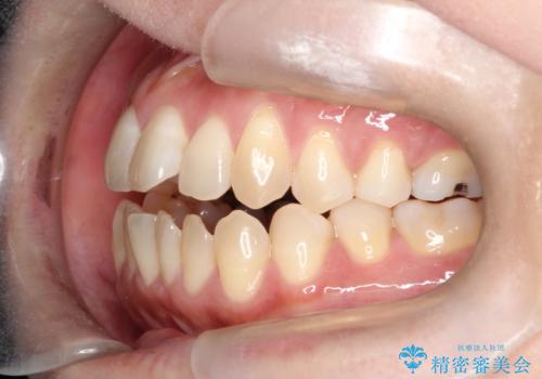 【インビザライン】オープンバイトを治したいの治療前