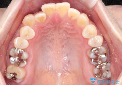 【インビザライン】オープンバイトを治したいの治療前