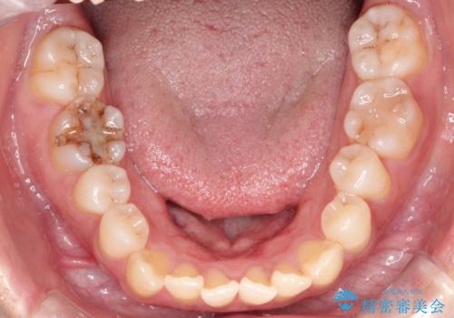 【インビザライン】オープンバイトを治したいの治療前
