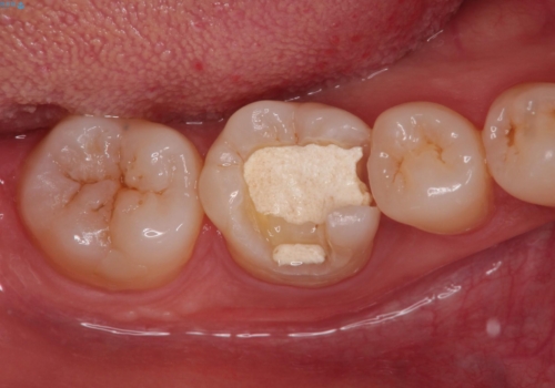 【根管治療】ラバーダムと顕微鏡を用いた治療の治療前