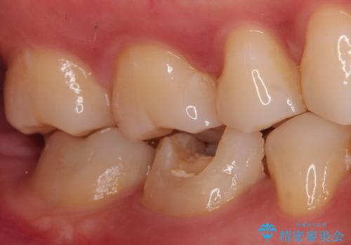 【根管治療】ラバーダムと顕微鏡を用いた治療の治療前