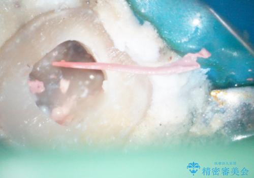 【根管治療】ラバーダムと顕微鏡を用いた治療の治療中