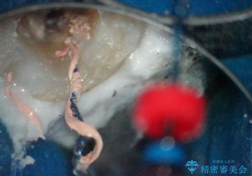 【根管治療】ラバーダムと顕微鏡を用いた治療の治療後