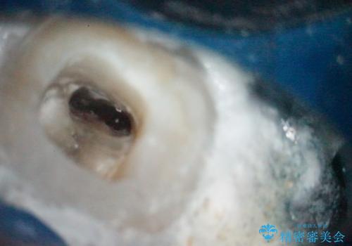 【根管治療】ラバーダムと顕微鏡を用いた治療の治療中