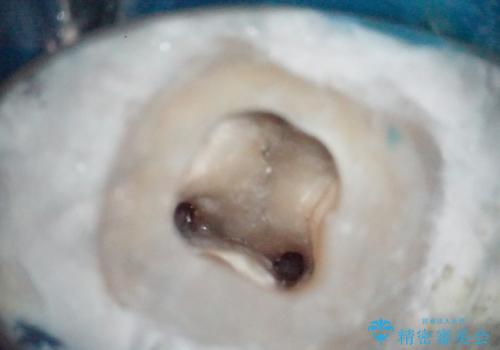 【根管治療】ラバーダムと顕微鏡を用いた治療の治療前