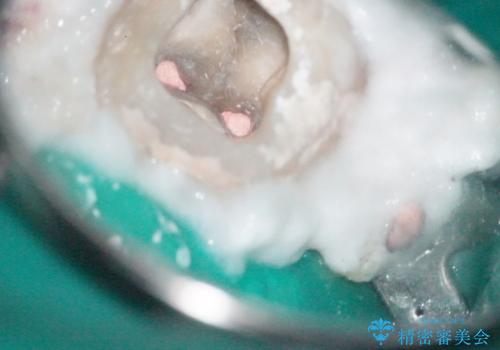 【根管治療】ラバーダムと顕微鏡を用いた治療の治療後