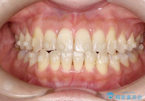 【インビザライン】オープンバイトを治したいの治療中