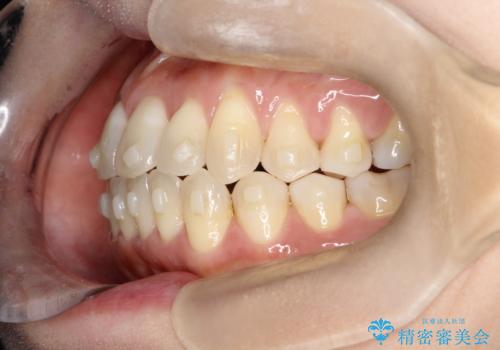 【インビザライン】オープンバイトを治したいの治療中