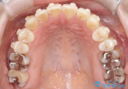 【インビザライン】オープンバイトを治したいの治療中