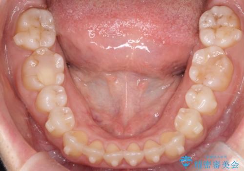 【インビザライン】オープンバイトを治したいの治療中