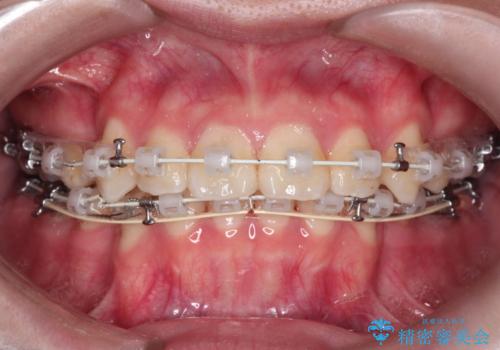 【抜歯ワイヤー矯正】前歯を引っ込めたいの治療中