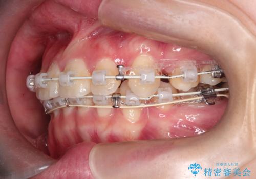 【抜歯ワイヤー矯正】前歯を引っ込めたいの治療中