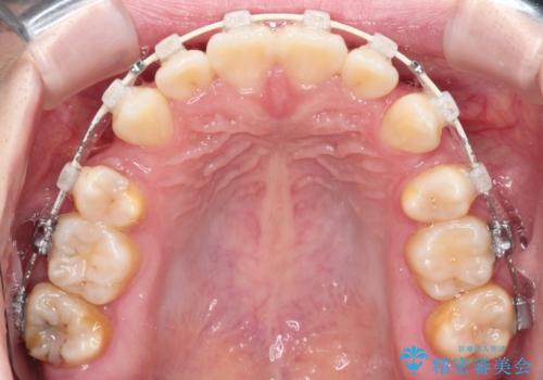 【抜歯ワイヤー矯正】前歯を引っ込めたいの治療中