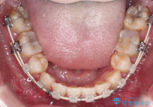 【抜歯ワイヤー矯正】前歯を引っ込めたいの治療中