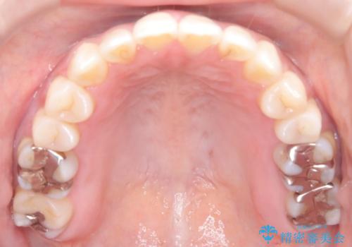 【インビザライン】オープンバイトを治したいの治療後