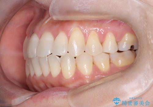 【インビザライン】オープンバイトを治したいの治療後