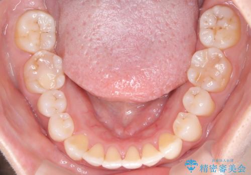 【インビザライン】オープンバイトを治したいの治療後