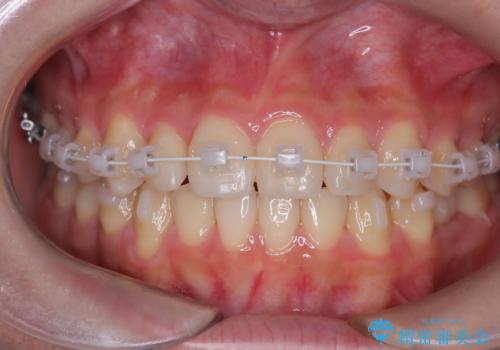 【ワイヤー矯正】インビザラインは途中でやめましたの治療中
