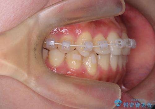 【ワイヤー矯正】インビザラインは途中でやめましたの治療中