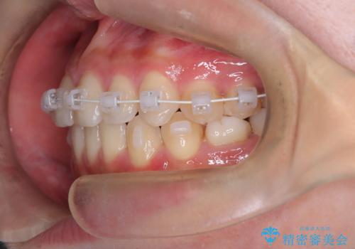 【ワイヤー矯正】インビザラインは途中でやめましたの治療中
