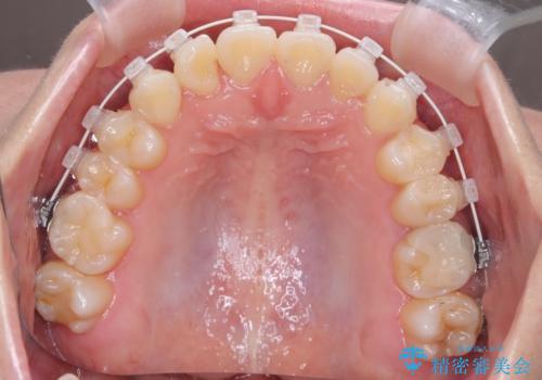 【ワイヤー矯正】インビザラインは途中でやめましたの治療中