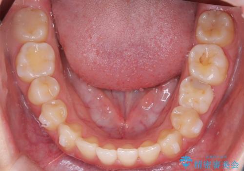 【ワイヤー矯正】インビザラインは途中でやめましたの治療中