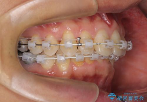 【遠心移動ワイヤー矯正】翼状捻転を治したいの治療中