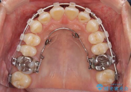 【遠心移動ワイヤー矯正】翼状捻転を治したいの治療中