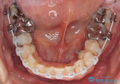 【遠心移動ワイヤー矯正】翼状捻転を治したいの治療中