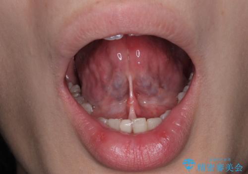 舌小帯の処置 滑舌が気になるの治療前