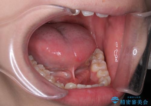 舌小帯の処置　滑舌が気になるの症例 治療前