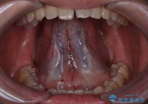 舌小帯の処置　滑舌が気になるの治療中