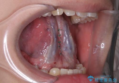 舌小帯の処置　滑舌が気になるの治療中
